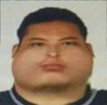 腮腺炎